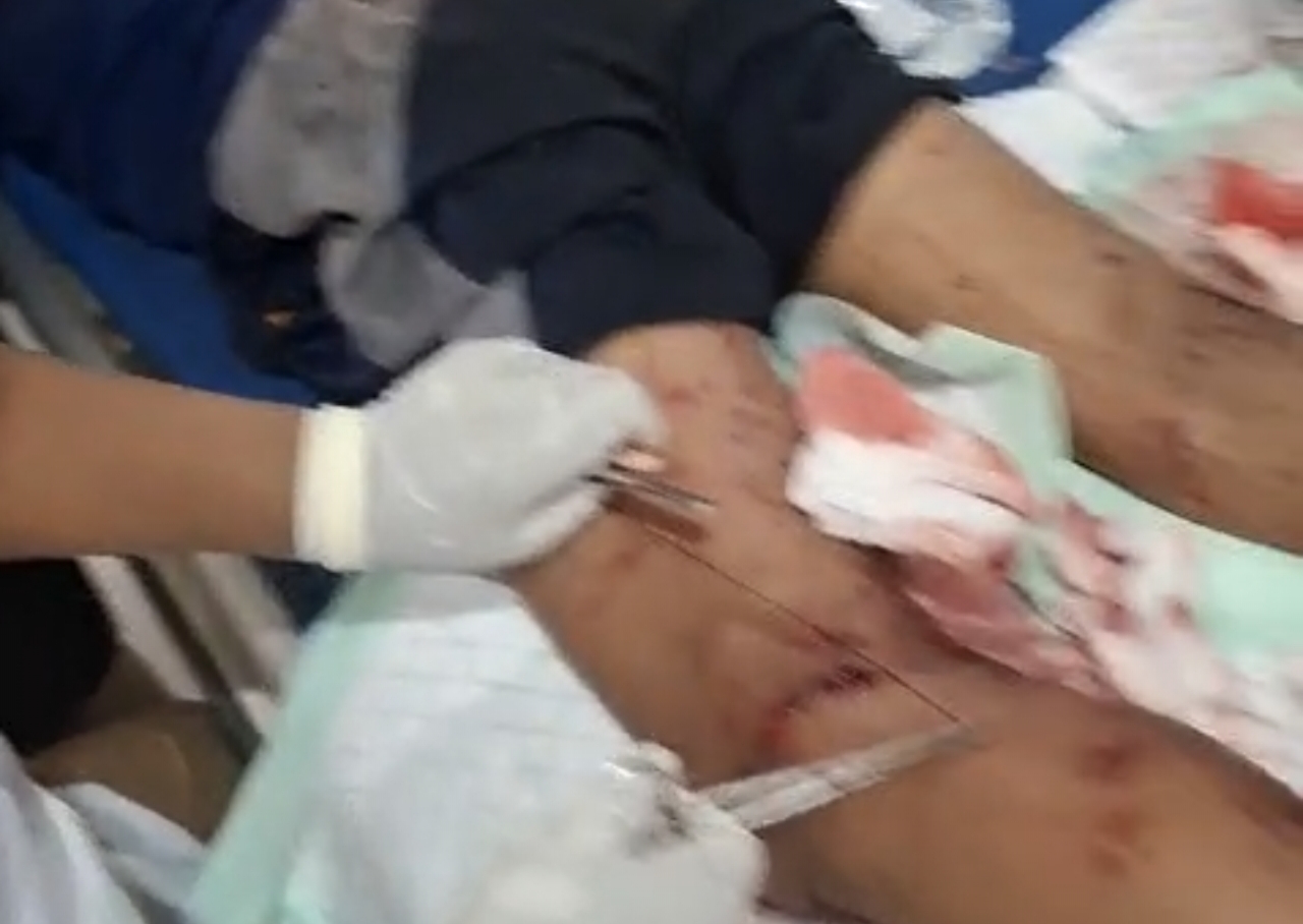 Ledakan Petasan di Kuripan, Pekalongan, 1 Tewas, Tangan Putus